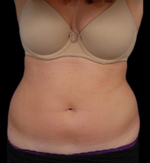 CoolSculpting