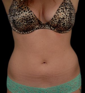 CoolSculpting