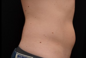 CoolSculpting