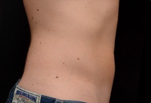 CoolSculpting