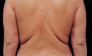 CoolSculpting