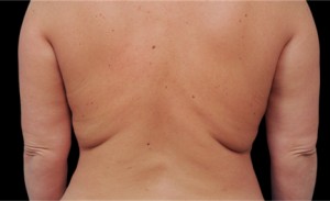 CoolSculpting