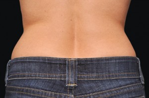 CoolSculpting