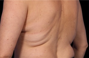 CoolSculpting