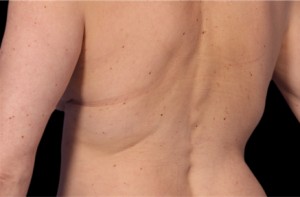 CoolSculpting