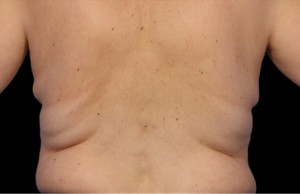 CoolSculpting