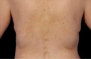 CoolSculpting
