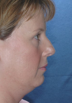 rhinoplasty