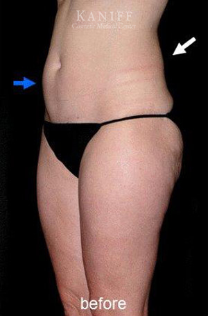 CoolSculpting