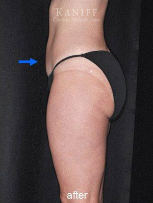 CoolSculpting