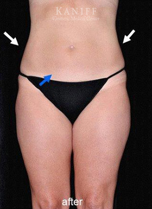 CoolSculpting