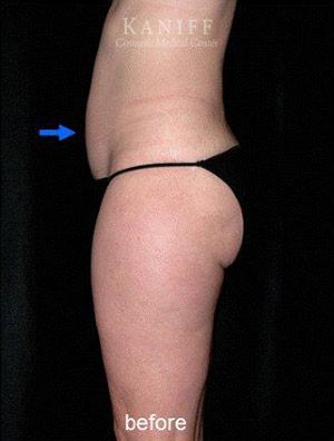 CoolSculpting
