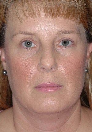 rhinoplasty