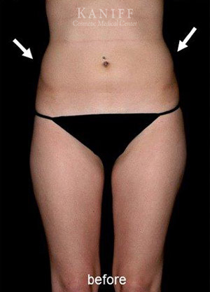 CoolSculpting