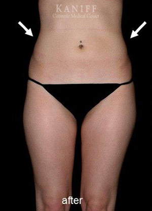 CoolSculpting