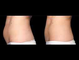 CoolSculpting