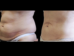 CoolSculpting