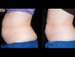 CoolSculpting