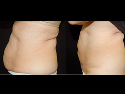 CoolSculpting
