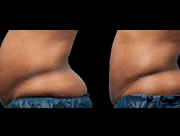 CoolSculpting
