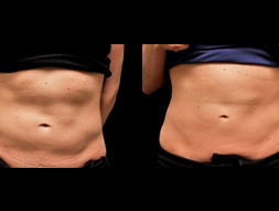 CoolSculpting