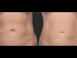 CoolSculpting