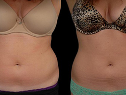 CoolSculpting
