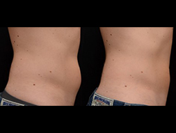 CoolSculpting