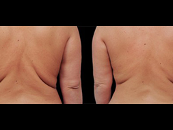 CoolSculpting