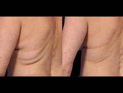 CoolSculpting