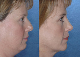 rhinoplasty