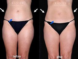 CoolSculpting