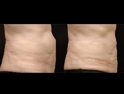 CoolSculpting