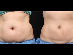 CoolSculpting