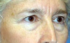 Eyelid Surgery