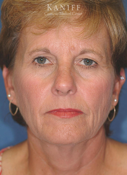 Brow lift