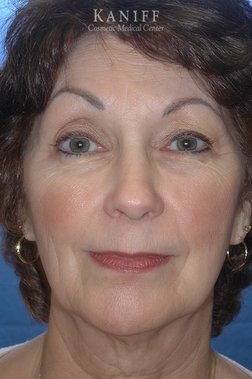 , Facelift