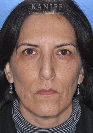 rhinoplasty