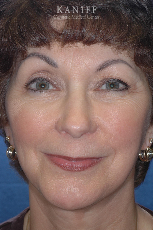 , Facelift