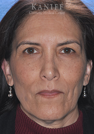 rhinoplasty