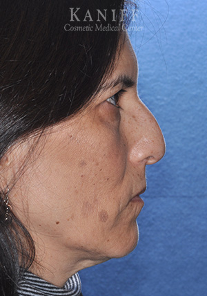 rhinoplasty