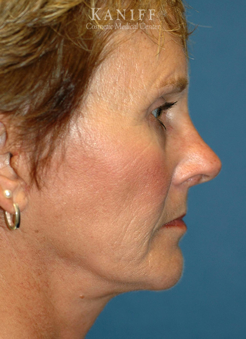 Brow lift