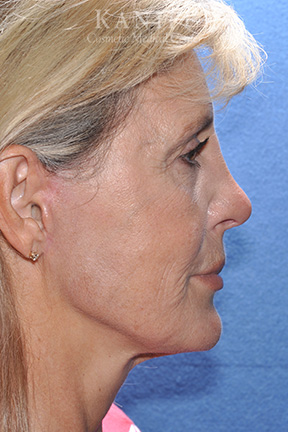 rhinoplasty
