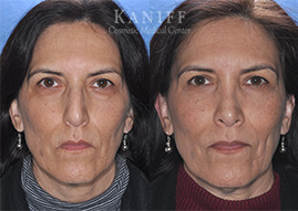 rhinoplasty