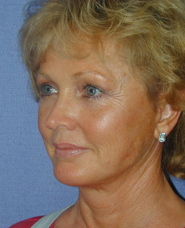 Brow Lift