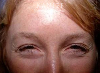 , Botox Cosmetic and Dysport