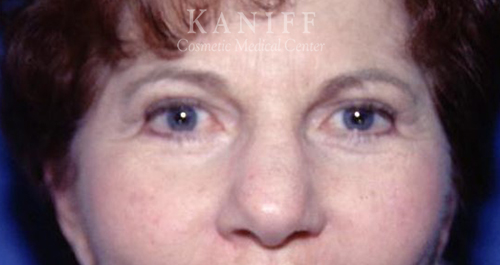 , Blepharoplasty (Eyelid Surgery)