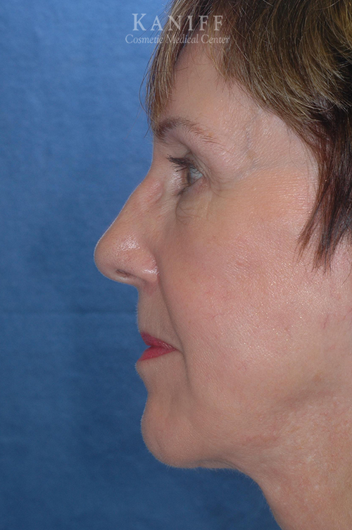 Neck Lift