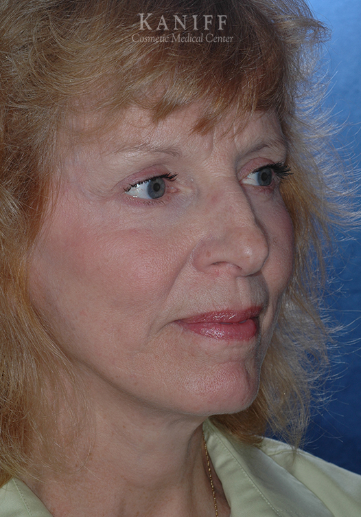 Brow Lift