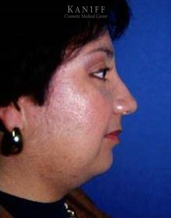 Neck Lift